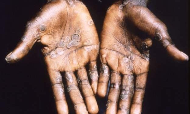 More global approach needed to control Monkeypox 