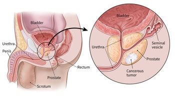 Prostate cancer – a largely overlooked disease