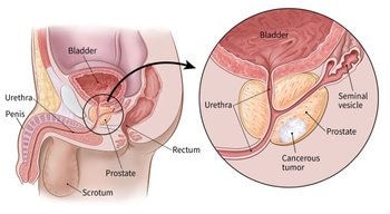 Prostate cancer – a largely overlooked disease