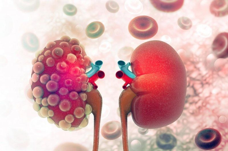Diabetes, high blood pressure major causes of chronic kidney disease – Specialist