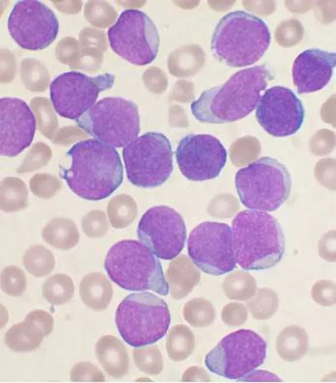 Leukaemia Foundation calls for stronger national support