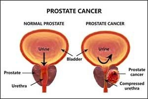 Gloria Yankson's thoughts ... The prostate and cancer – what every man needs to know