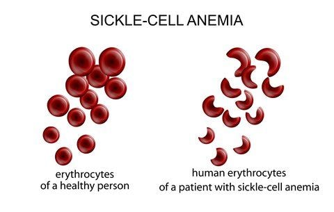 Sickle-cell new-born screening launched at 37, Greater Accra Regional Hospital
